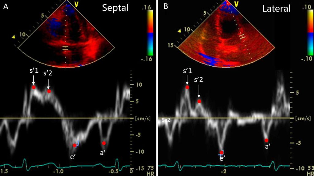Figure 13a. Mitral annulus tissue Doppler normal flow velocity profiles: 