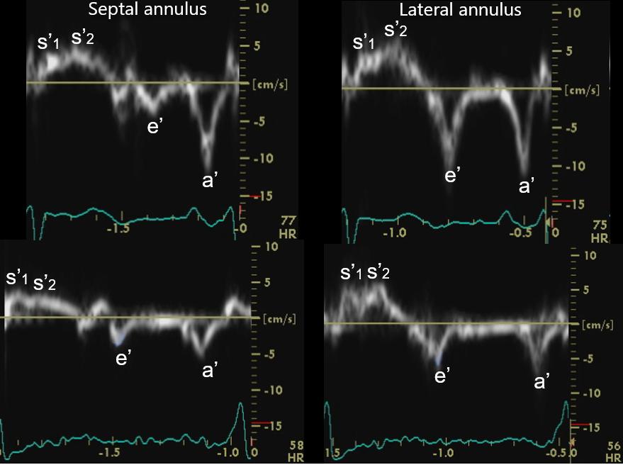 Figure 13b. Mitral annulus tissue Doppler flow velocity profiles i