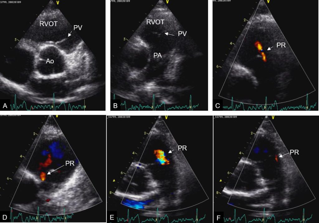 Figure 15a. Pulmonary valve anatomy and examples of color Doppler pulmonary regurgitation