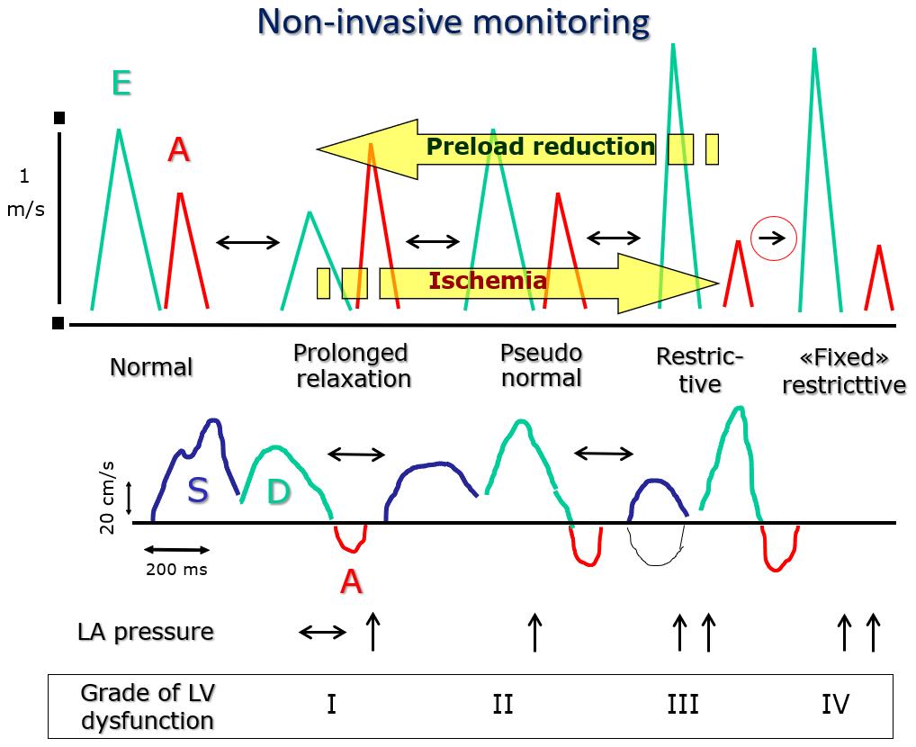 Figure 19. Effects of preload reduction (example: Valsalva maneuver) and ischemis on the pulsed Doppler mitral valve and pulmonary venous flow profiles.