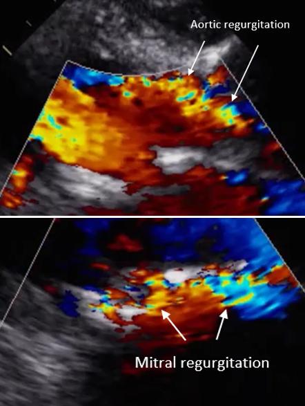 Color Doppler parasternal long axis view with anteriorly directed aortic regurgitation and anteriorly directed mitral regurgitation. 