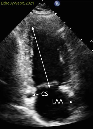 Figure 25. 2D apical 2-chamber view with view markeresç coronary sinus, left atrial appendage and left ventricular long axis