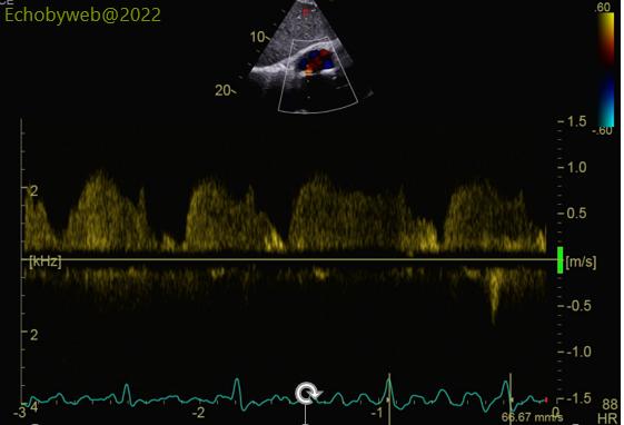 Figure 16. Subcostal view. Pulsed Doppler interrrogation of atrial septal defect flow, with the ECG trace