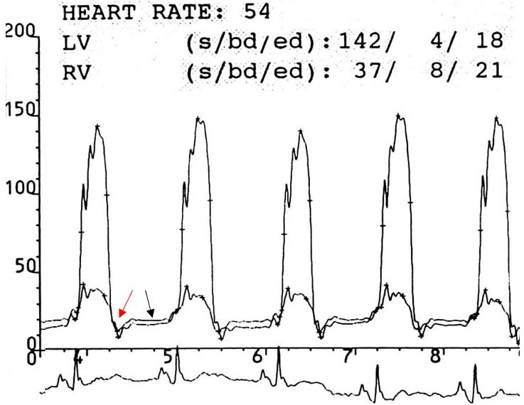 Figure 79. Left ventricular and right ventricular pressure tracings, constrictive pericarditis