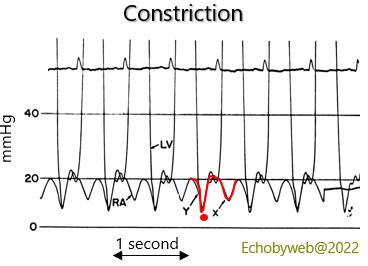 Figure 10. Right atrial pressure in pericardial constriction