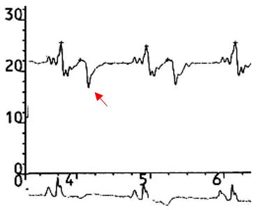 Figure 80. Right atrial pressure tracing, constrictive pericarditis