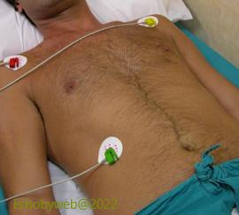 Figure 11. ECG lead positioning, supine patient