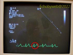 Figure 13. ECG tracing on the monitor of the ultrasound unit