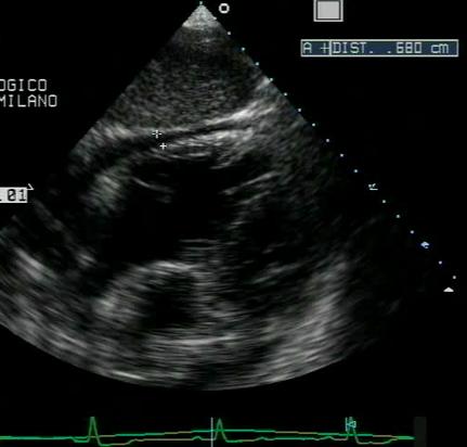 Figure 18. 2D subcostal 4-chamber view, measurement of effusion lateral to the right ventricle