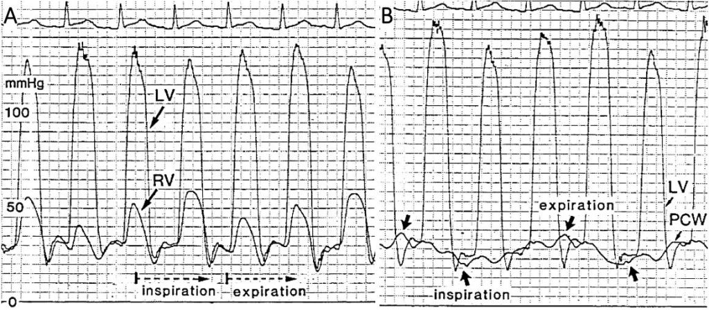 Figure 81. Left and right heart hemodynamics in pericardial constriction