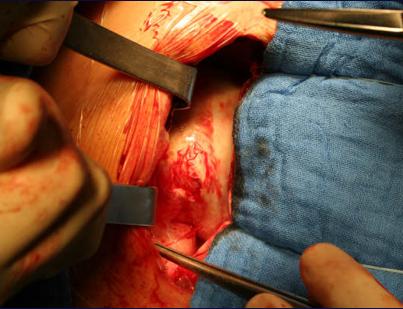 Open heart surgery:  surgical exposure of pericardium