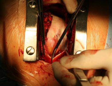 Open heart surgery: Anterior pericardiotomy