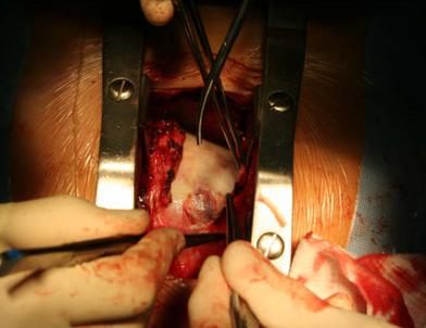 Open heart surgery: removal of anterior pericardium
