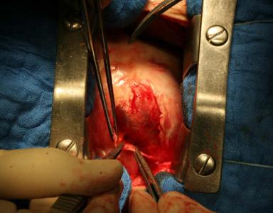Open heart surgery: removal of anterior pericrdium