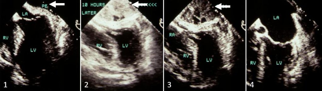 Figure 63. TE exam, lower esophagus 4-chamber. Progression of pericardial hematoma lateral to the left atrium