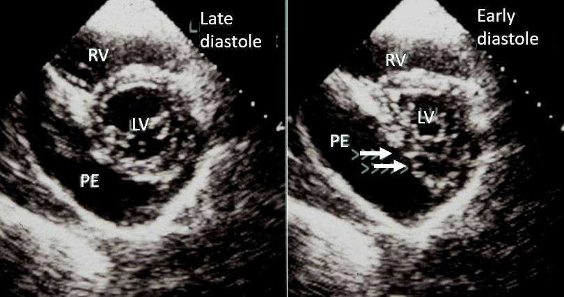 Figure 70. Severe pericardial effusion posterior to the left ventricle