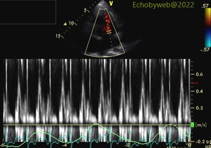 Figure 21. Pulsed Doppler mitral valve flow velocities with no respiratory signs of pericardial constriction