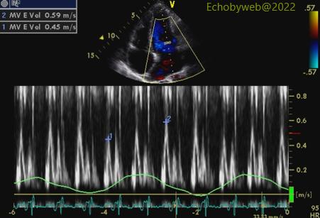 Figure 20. Pulsed Doppler mitral valve flow velocities with respiratory signs of pericardial constriction