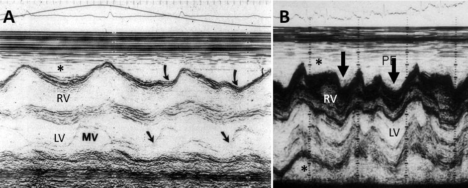 Figure 49. A. Partial early diastolic collapse and B. complete diastolic collapse of the RV free wall 