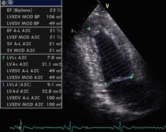 Clinical example of correct positioning of the transducer on the left ventricular long axis