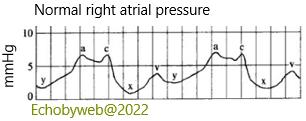 Figure 8. Normal right atrial pressure
