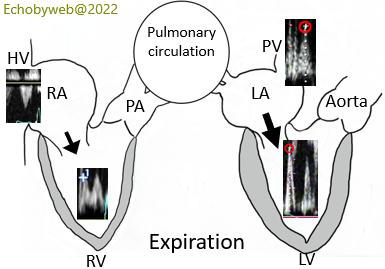 Figures 89. Right and left heart reciprocal modifications of filling velocities during respiration: expiration