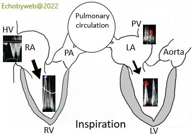 Figures 88. Right and left heart reciprocal modifications of filling velocities during respiration: inspiration.