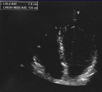 Clinical example of left ventricular long axis foreshortening