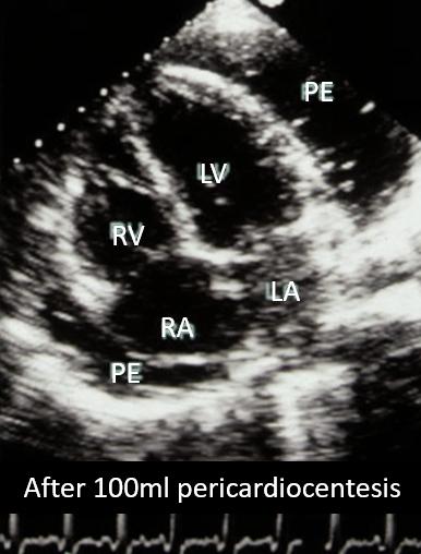 Figure 77. 2D apical 4-chamber. Resolution of right atrial wall collapse after pericardiocentesis