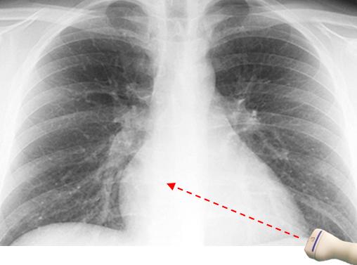 Simulated transducer positioning on chest Xray in a subject with LV long axis more parallel to the diaphragm