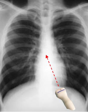Simulated transducer positioning on chest Xray in a subject with the LV long axis parallel to the spine