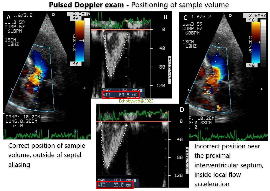 Figure 9. Pulsed Doppler exam. Correct and incorrect positioning of sample volume in the left ventricular outflow tract