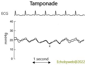 Figure 9. Right atrial pressure in tamponade