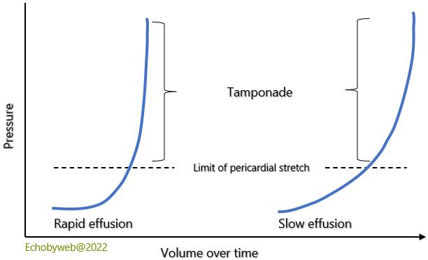 Figure 36. Rapid versus slow evolution over time of pericardial effusion