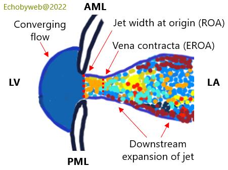 Cartoon of the anatomy of color Doppler flow through a restricted orifice (mitral regurgitant orifice)