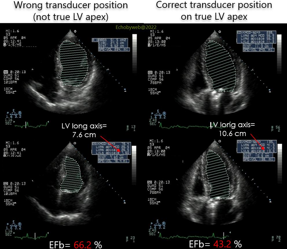Figure 4. Effects of incorrect apical positioning of the transducer in the apical 4-chamber view