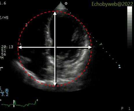 Circular geometry of the apical 4-chambers view with left ventricular long axis foreshortening