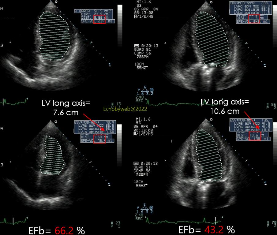 Erroneous calculation of left ventricular volumes and ejection fraction when the long axis is foreshortened
