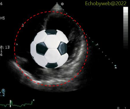 The incorrect imaging of the apical 4-chamber view resembles a football (soccer)