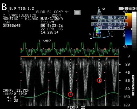 Figure 86B. Pulsed Doppler LV outflow flow velocity in pericardial constriction