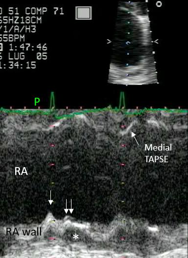 Figure 40. M-mode of the superior RA wall. Difference between right atrial systolic contraction and atrial early systolic collapse