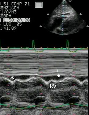 Figure 51. M-mode subcostal 4-chamber, RV free wall. Prolonged diastolic collapse of the RV lateral wall