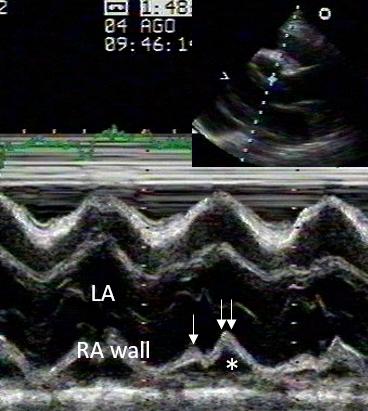 Figure 44. M-mode of the posterior LA wall. Holosystolic collapse of the RA wall.