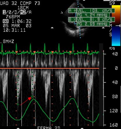 Figure 55. Pulsed Doppler apical 5-chamber, LVOT. Inspiratory reduction of left ventricular outflow