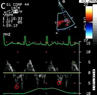 Figure 86C. Tissue Doppler mitral lateral velocities in pericardial constriction