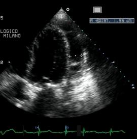 Figure 92. 2D apical 4-chamber. Effusive-constrictive pericarditis. 