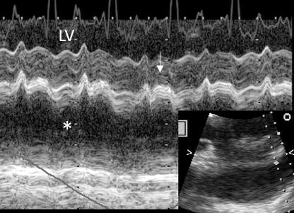 Figure 62. M-mode subcostal, LV lateral wall. Pericardial tamponade in patient with localized severe effusion