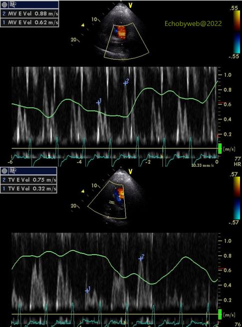 Figure 96. Pulsed Doppler mitral and tricuspid flow velocities with typical signs of pericardial constriction