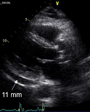 Figure 27. 2D parasternal long axis, mild to moderate effusion