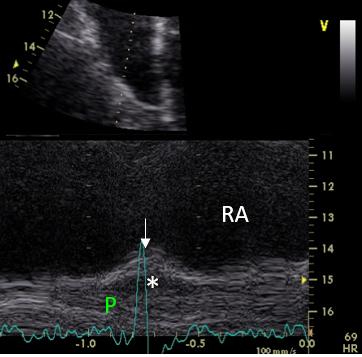 Figure 46. M-mode of the superior RA wall. Right atrial systolic contraction
